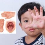 HFMD Kanak-Kanak: Tanda Awal, Ulser & Rawatan di Rumah