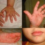 HFMD in Kids: Spot Warning Signs, Ulcers & Safe Care