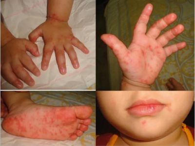HFMD in Kids Spot Warning Signs, Ulcers & Safe Care